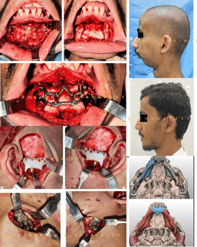 Bimaxillary orthognathic osteotomies – step-by-step intraoperative images and facial outcome