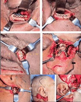 Intraoral fixation plates and soft-tissue handling in maxillofacial surgery – clinical collage