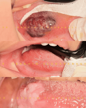 Oral cavity lesion resection and reconstruction – maxillofacial surgery case by Prof. Dr Ibrahim Elsharabasy