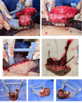 Segmental mandibular osteotomy with digital cutting guide and reconstruction plate – Prof. Dr Ibrahim Elsharabasy