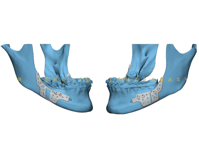 3D mandible model with bilateral plates showing stable fixation after mandibular osteotomies.