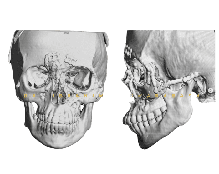 ARCAS Extraoral Approaches – BSSO and Mandibular Fixation