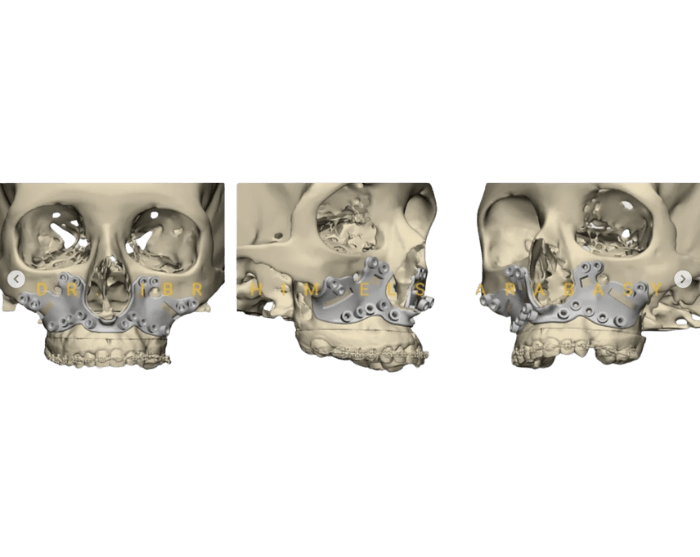 Orthognathic skeletal reconstruction after Le Fort and BSSO osteotomies